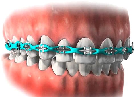 cadena de metal brackets|cadenas de goma dental.